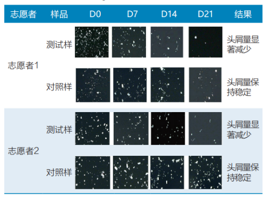 頭皮,健康,頭皮脫屑,頭皮皮脂